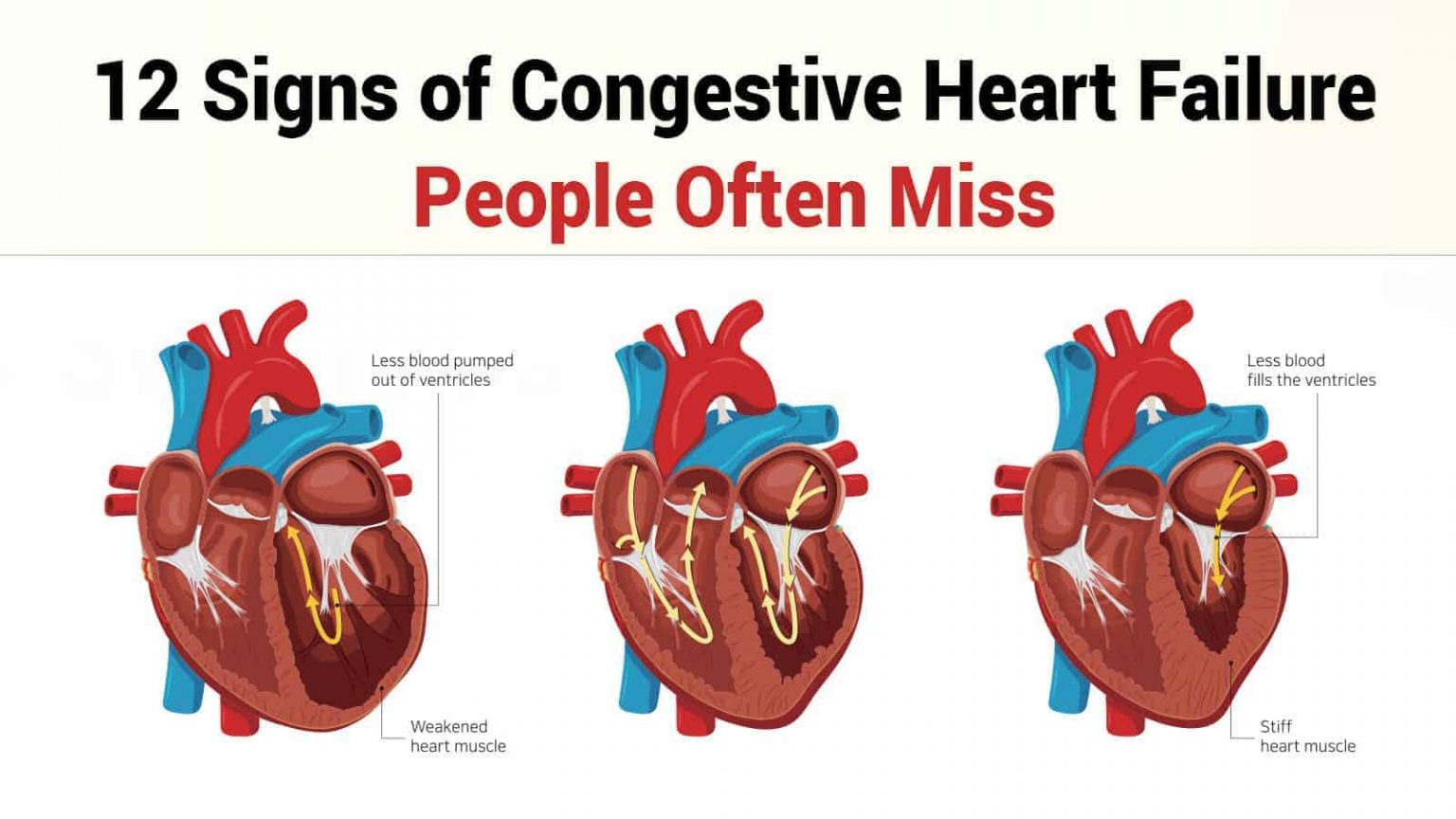 congestive-heart-failure-common-reasons-for-chf-ausmed