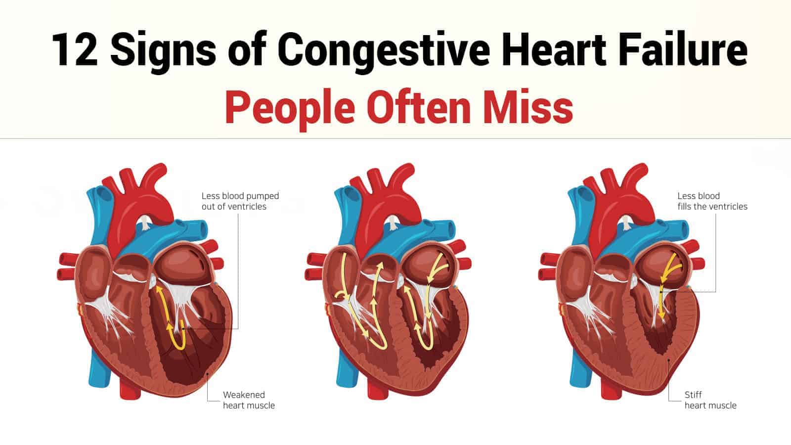 12 Congestive Heart Failure Symptoms Causes Diagnosis Treatments And Preventions