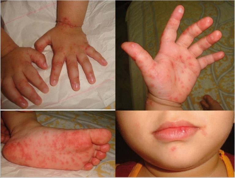 7 Hand Foot And Mouth Disease Symptoms, Causes, Diagnosis & Treatment