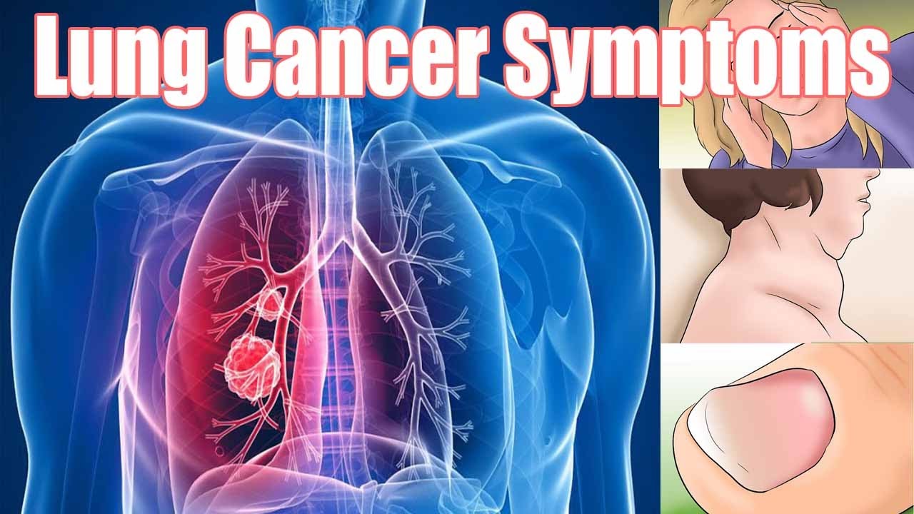 12 Lung Cancer Symptoms – Causes, Risk Factor, Diagnosis & Treatments
