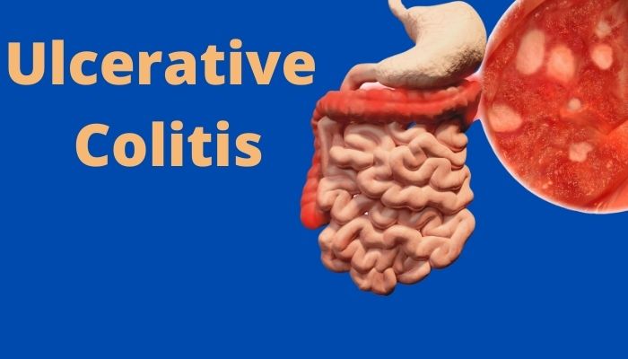 What is Ulcerative Colitis? – Symptoms, Causes, Treatment & More
