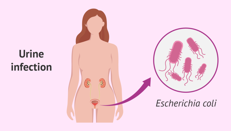 What is Urinary Tract Infection?