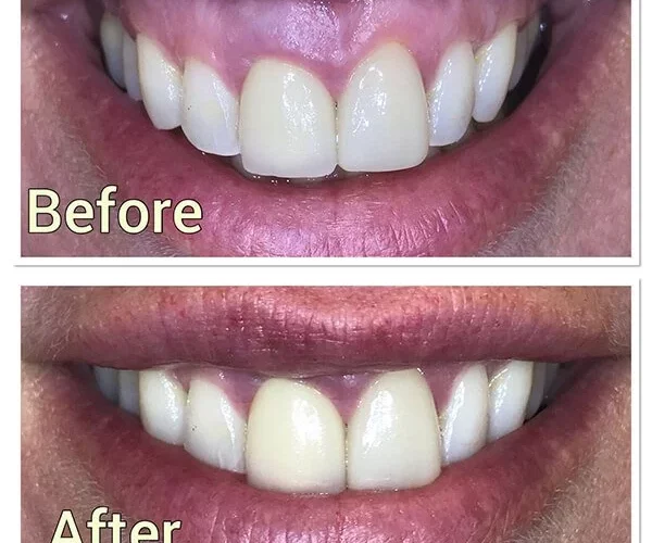 Frenectomy Ruined My Smile: Frenectomy Reviews & Complications